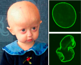 952px-hutchinson-gilford_progeria_syndrome